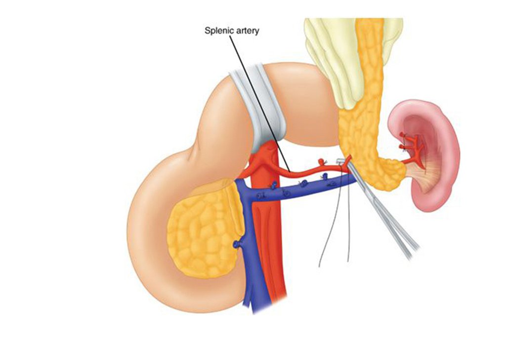 dr-anand-vijai-distal-pancreatectomy