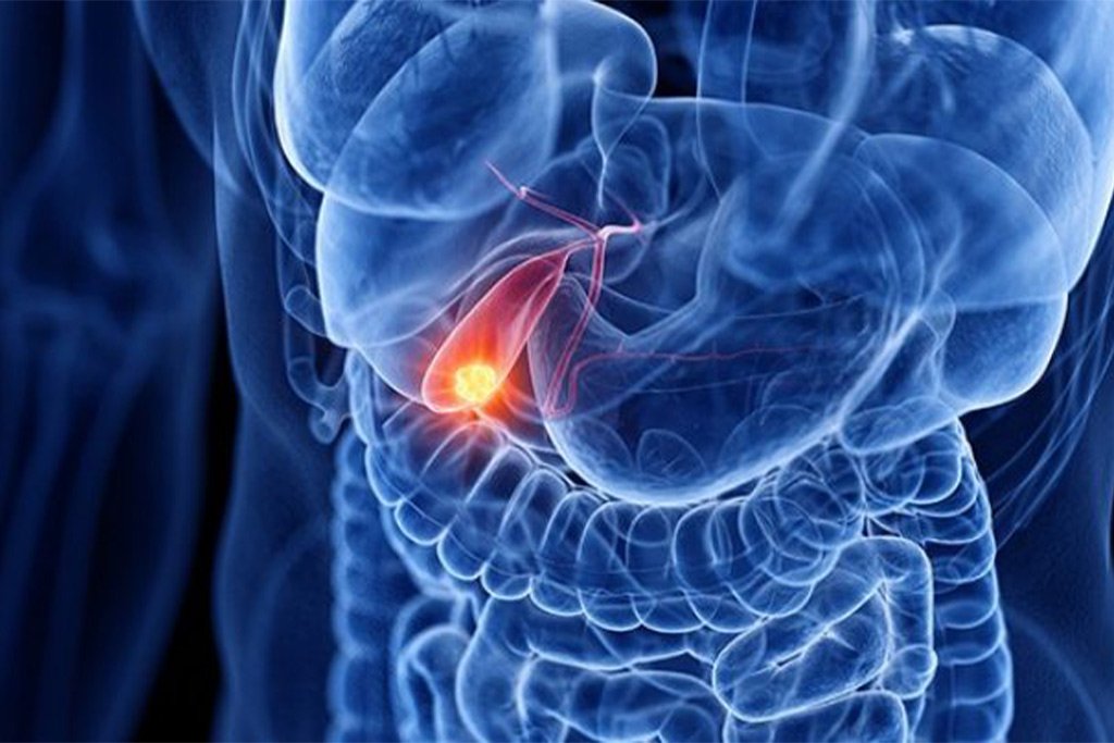 dr-anand-vijai-gallbladder-cancer-surgery
